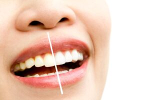How to Maintain a Bright Smile After Whitening?