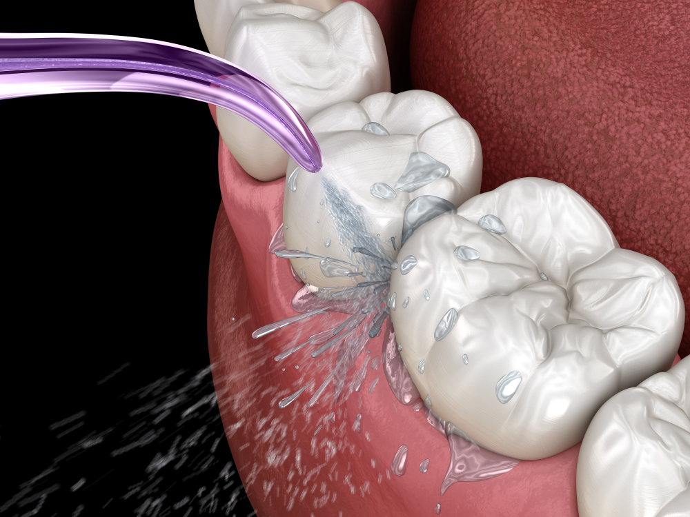 unlocking the secrets of dental cleanings for a bright smile
